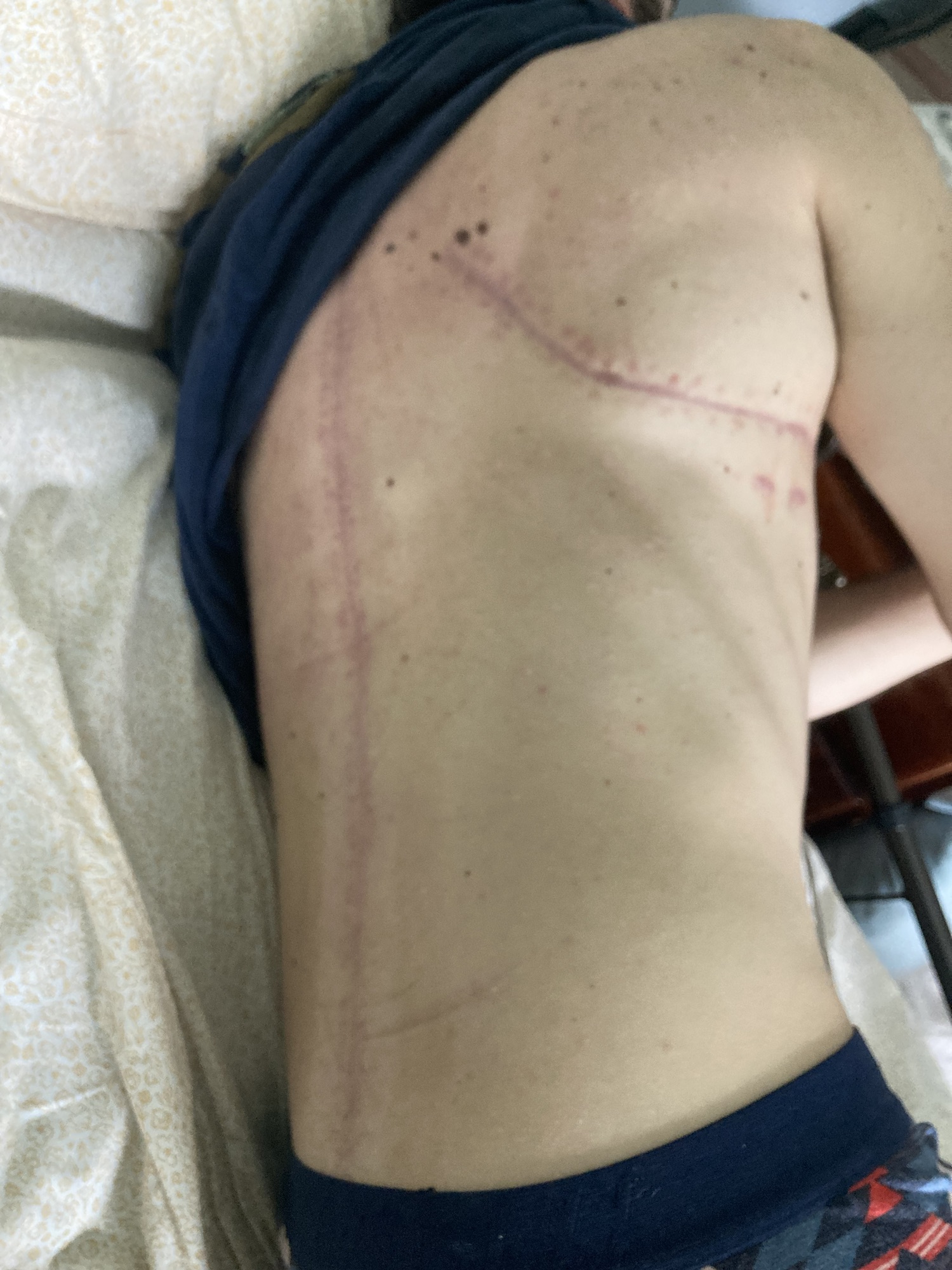 September 6th 2023 – Healing&nbsp;Scar