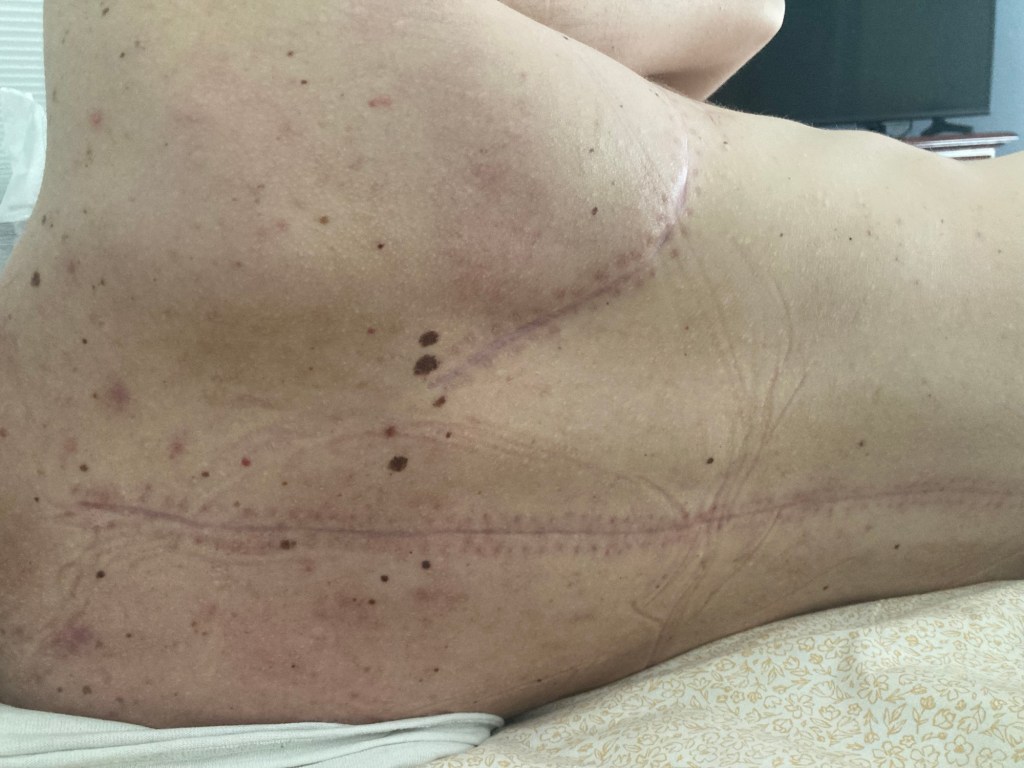 More Tossing & Turning – Therapy for SCI Recovery | Aug 6 – 12&nbsp;2023